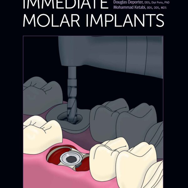 Immediate Molar Implants